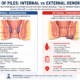 Internal vs External Hemorrhoids