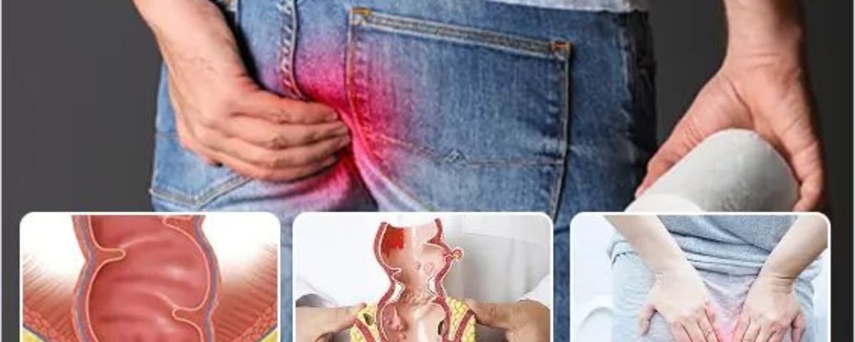 Pilonidal Sinus Symptoms