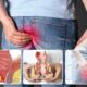 Pilonidal Sinus Symptoms